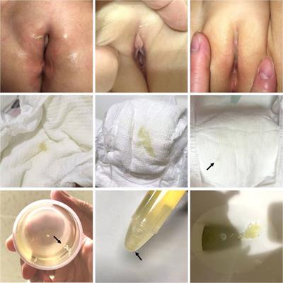Urethral discharge as an early manifestation of urinary tract infection in children ≤24 months old